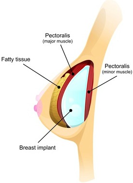 Learn about breastfeeding with breast implants