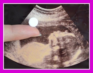 Breastfeeding-as-birth-control